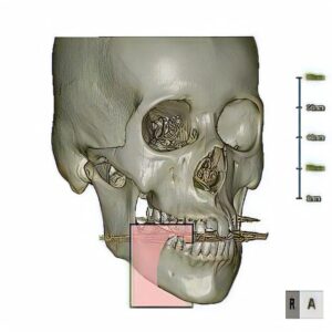 下顎や上顎部分を縦に割ってCT画像を表示させます。
