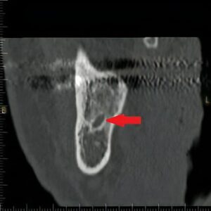 神経の穴の内側にある空洞部分があご骨の中の動脈・神経が通る穴です。