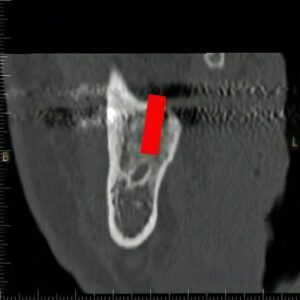 神経の穴の上部分にインプラント体を埋め込みます。