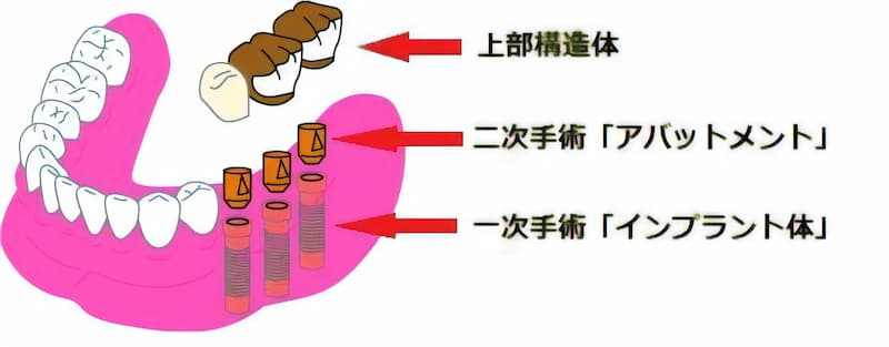 インプラントの頭の部分となる上部構造体（口腔内に出る歯の部分）を接続するにあたり、一次手術でネジ受けのナット部分（インプラント体）を、二次手術で接続するネジ部分（アバットメント）を作成・埋め込みします。