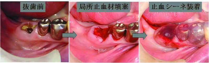 抜歯後は、くぼみを埋めて止血装置(止血シーネ)を装着して止血します