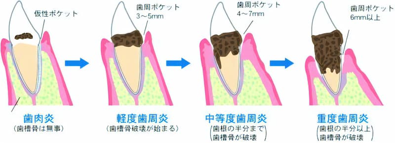 初期は歯肉炎から始まります。次の段階に進むと軽度歯周炎となり歯槽骨の破壊が始まります。さらに進むと中度歯周炎となり歯根の半分まで歯槽骨が破壊されます。最終段階まで進むと歯根の半分以上歯槽骨が破壊され、歯周ポケットは6ｍｍ以上となります。