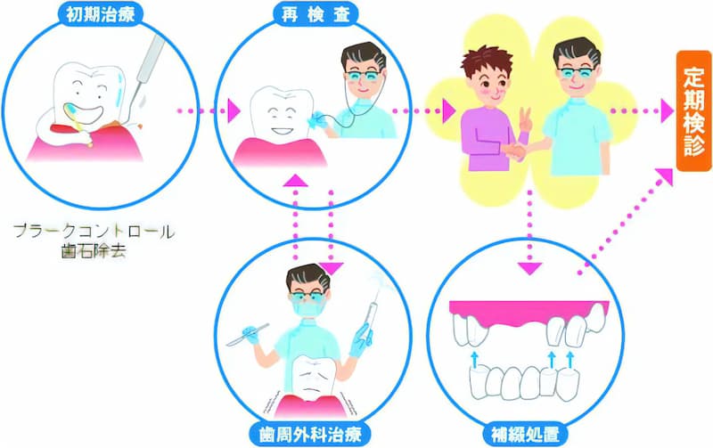 初期はプラークコントロールや歯石除去をおこないます。その後再検査をし、必要に応じて歯周外科治療をおこないます。さらにその後は経過観察で補綴処置(失われた歯の部分を詰め物や入れ歯で補う処置)をしながら定期検診をおこないます。